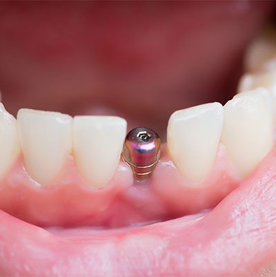 A patients mouth with a dental implant between teeth