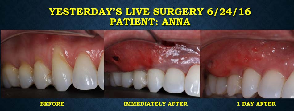 Anna's mouth before, immediately after, and 1 day after the Pinhole surgical technique