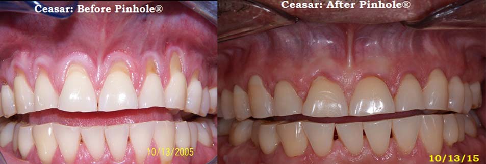 Ceasar's mouth before the Pinhole surgical technique on the left and after on the right