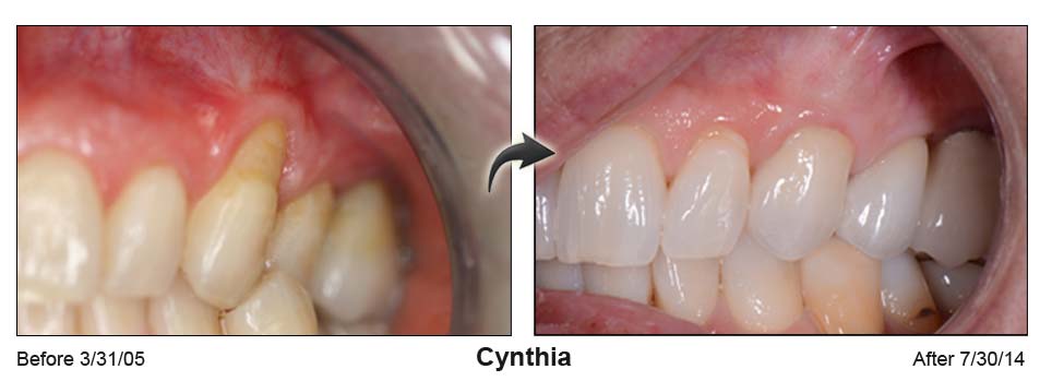 Cynthia's mouth before the Pinhole surgical technique on the left and after on the right