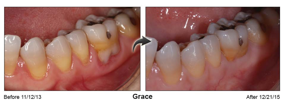Grace's mouth before the Pinhole surgical technique on the left and after on the right