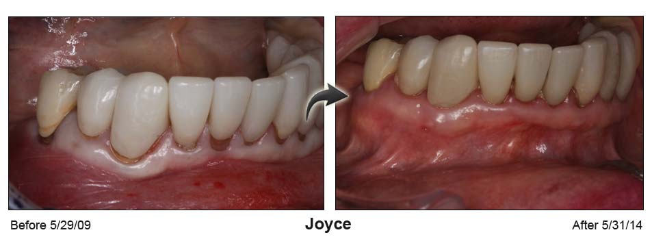Joyce's mouth before the Pinhole surgical technique on the left and after on the right