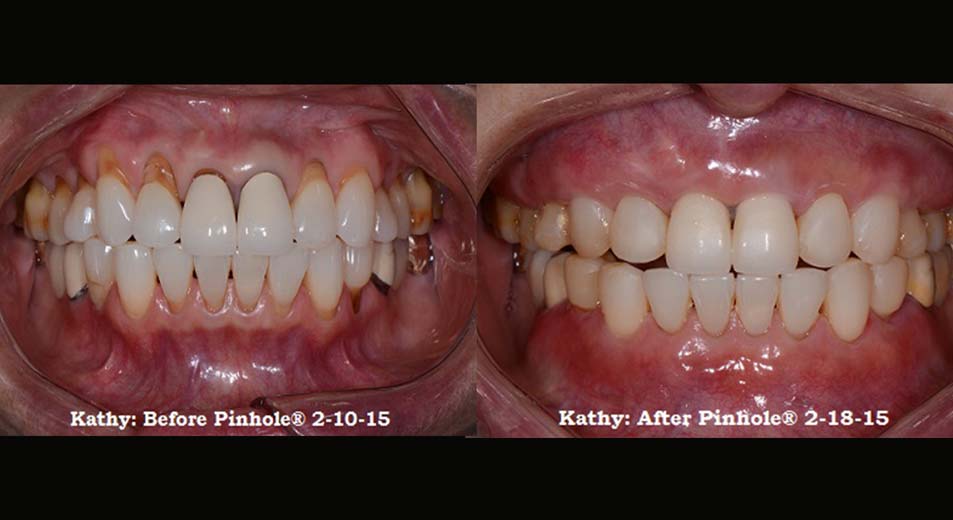 Kathy's mouth before the Pinhole surgical technique on the left and after on the right