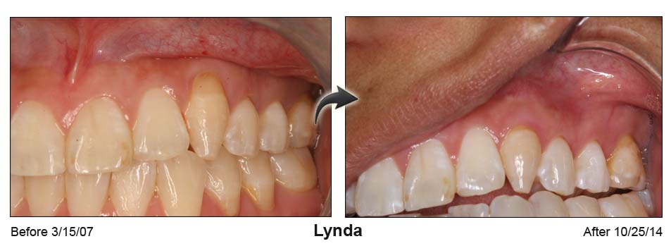 Lynda's mouth before the Pinhole surgical technique on the left and after on the right
