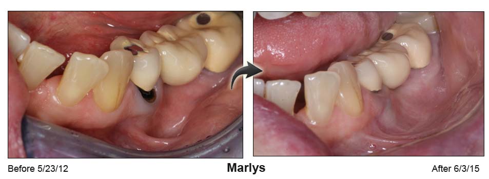 Marlys' mouth before the Pinhole surgical technique on the left and after on the right
