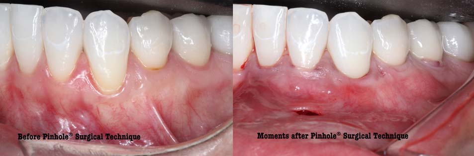 A mouth before the Pinhole surgical technique on the left and after on the right