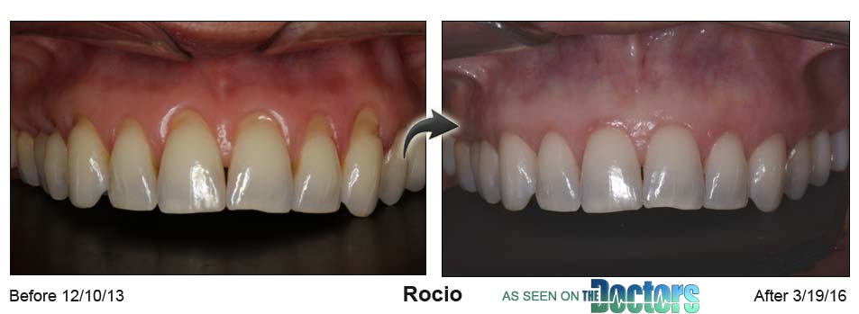 Rocio's mouth before the Pinhole surgical technique on the left and after on the right