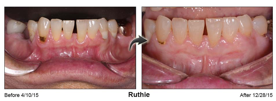 Ruthie's mouth before the Pinhole surgical technique on the left and after on the right