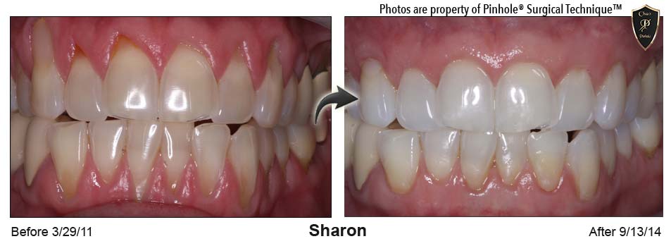 Sharon's mouth before the Pinhole surgical technique on the left and after on the right
